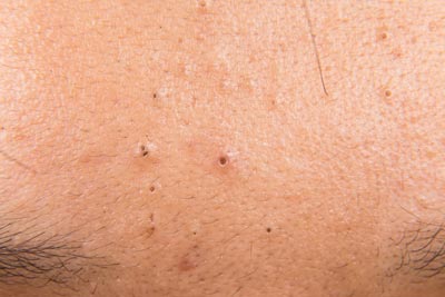 Blackhead
